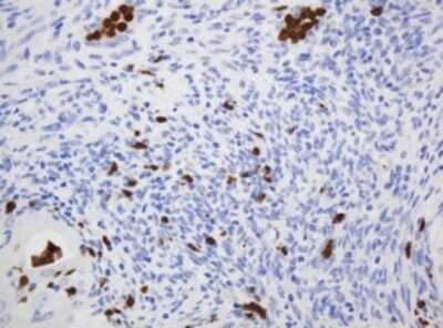 Immunohistochemistry: CNKSR3 Antibody (OTI1D7) - Azide and BSA Free [NBP2-72428] - Analysis of Adenocarcinoma of Human endometrium tissue. (Heat-induced epitope retrieval by 10mM citric buffer, pH6.0, 120C for 3min)
