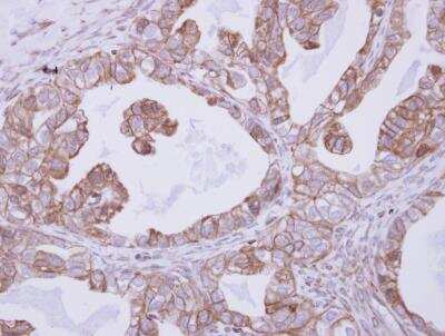 Immunohistochemistry-Paraffin: CNNM4 Antibody [NBP2-15927] - Analysis of paraffin-embedded Ovarian carcinoma, using antibody at 1:250 dilution.