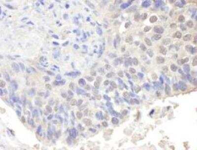 Immunohistochemistry-Paraffin: CNOT3 Antibody [NBP1-21396] - of human ovarian carcinoma. Dilution of 1:1,000 (1ug/ml).