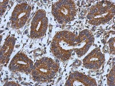 Immunohistochemistry-Paraffin: CNOT7 Antibody [NBP2-15929] -  Human colon carcinoma, using CNOT7  antibody at 1:500 dilution. Antigen Retrieval: Trilogy™ (EDTA based, pH 8.0) buffer, 15min. 