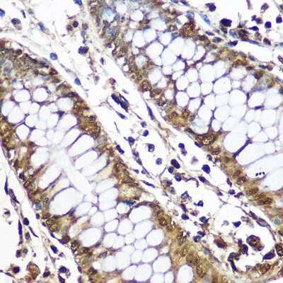 Immunohistochemistry-Paraffin: CNOT7 Antibody [NBP2-92571] - Immunohistochemistry of paraffin-embedded Human colon using CNOT7 Rabbit pAb (NBP2-92571) at dilution of 1:50 (40x lens). Perform microwave antigen retrieval with 10 mM PBS buffer pH 7.2 before commencing with IHC staining protocol.