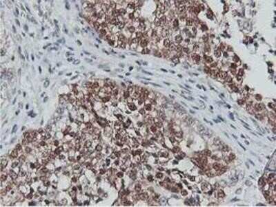 Immunohistochemistry-Paraffin: COASY Antibody (OTI3B3) [NBP2-01081] - Staining of paraffin-embedded Adenocarcinoma of Human ovary tissue using anti-COASY mouse monoclonal antibody.