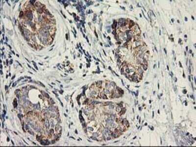 Immunohistochemistry: COCO/DAND5 Antibody (OTI2H3) - Azide and BSA Free [NBP2-72456] - Staining of paraffin-embedded Adenocarcinoma of Human breast tissue using anti-DAND5 mouse monoclonal antibody.