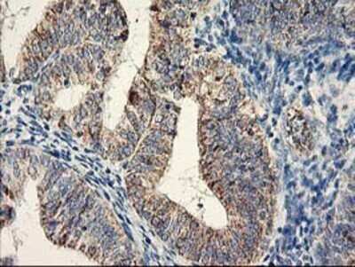 Immunohistochemistry: COCO/DAND5 Antibody (OTI2H3) - Azide and BSA Free [NBP2-72456] - Staining of paraffin-embedded Adenocarcinoma of Human endometrium tissue using anti-DAND5 mouse monoclonal antibody.