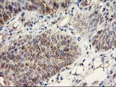 Immunohistochemistry: COCO/DAND5 Antibody (OTI2H3) - Azide and BSA Free [NBP2-72456] - Staining of paraffin-embedded Carcinoma of Human bladder tissue using anti-DAND5 mouse monoclonal antibody.