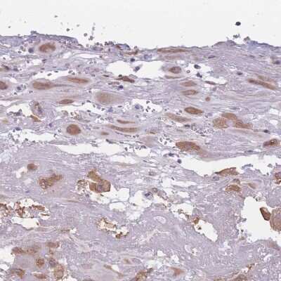 Immunohistochemistry-Paraffin: COL27A1 Antibody [NBP2-30615] - Staining of human placenta shows cytoplasmic positivity in decidual cells.