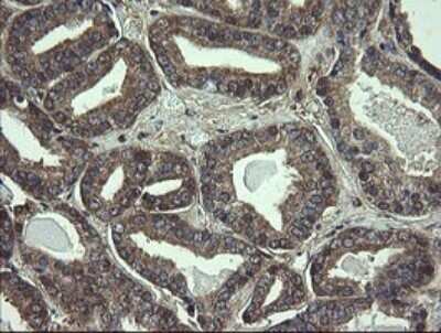 Immunohistochemistry: COMMD1 Antibody (2E2) [NBP2-46331] - Analysis of Carcinoma of Human prostate tissue.