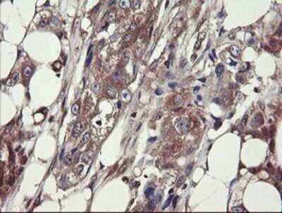 Immunohistochemistry: COMMD1 Antibody (2E2) [NBP2-46331] - Analysis of Adenocarcinoma of Human breast tissue.