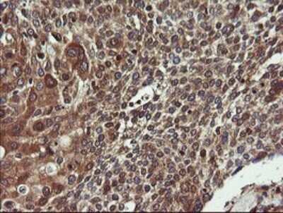 Immunohistochemistry: COMMD1 Antibody (2E2) [NBP2-46331] - Analysis of Carcinoma of Human bladder tissue.