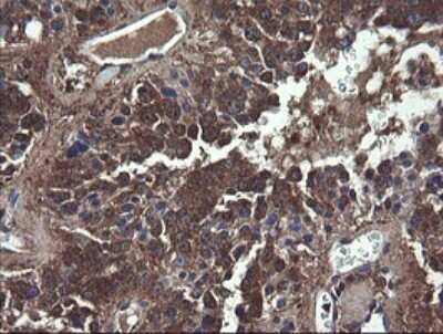 Immunohistochemistry: COMMD1 Antibody (2E2) [NBP2-46331] - Analysis of Carcinoma of Human pancreas tissue.