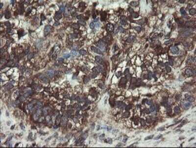 Immunohistochemistry: COMMD1 Antibody (2E2) [NBP2-46331] - Analysis of Adenocarcinoma of Human ovary tissue.