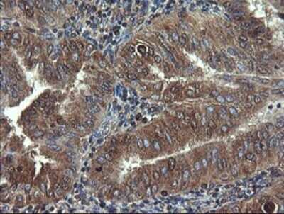 Immunohistochemistry: COMMD1 Antibody (2E2) [NBP2-46331] - Analysis of Adenocarcinoma of Human endometrium tissue.