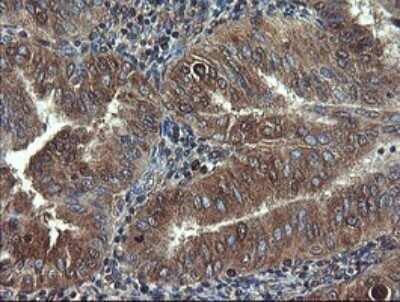 Immunohistochemistry: COMMD1 Antibody (OTI2E2) - Azide and BSA Free [NBP2-72418] - Analysis of Adenocarcinoma of Human endometrium tissue.