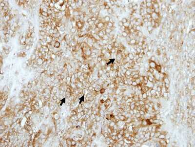 Immunohistochemistry-Paraffin: COMT Antibody [NBP2-15954] - Immunohistochemical analysis of paraffin-embedded DLD1 xenograft, using antibody at 1:500 dilution.