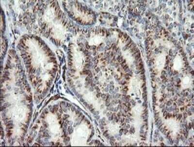 Immunohistochemistry: COPS6 Antibody (OTI4E7) [NBP2-46333] - Analysis of Carcinoma of Human thyroid tissue. (Heat-induced epitope retrieval by 10mM citric buffer, pH6.0, 120C for 3min)