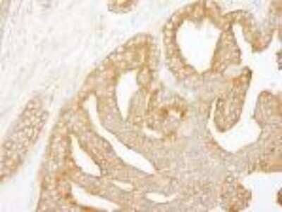 Immunohistochemistry-Paraffin: CORO1B Antibody [NB100-61040] - FFPE section of human prostate carcinoma.  Affinity purified rabbit anti-Coronin 2 used at a dilution of 1:250.