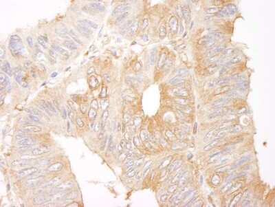 <b>Independent Antibodies Validation and Biological Strategies Validation.</b>Immunohistochemistry-Paraffin: CORO1B Antibody [NB100-61040] - Human colon carcinoma.  Antibody used at a dilution of 1:1,000.