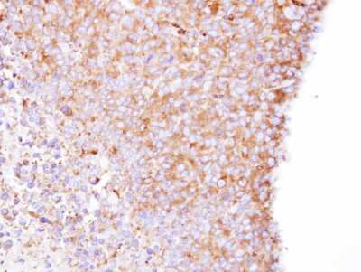 Immunohistochemistry-Paraffin: CORO1B Antibody [NBP1-32514] - Paraffin-embedded H1299 xenograft, using antibody at 1:500 dilution.