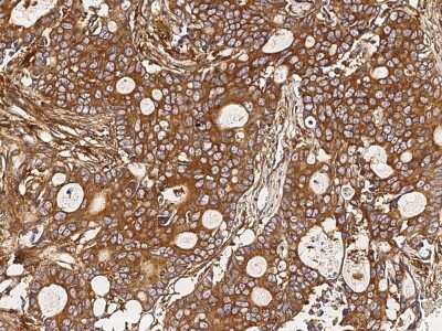 Immunohistochemistry-Paraffin: CORO2A Antibody [NBP2-99188] - Immunochemical staining of human CORO2A in human colon carcinoma with rabbit polyclonal antibody (1:1000, formalin-fixed paraffin embedded sections).