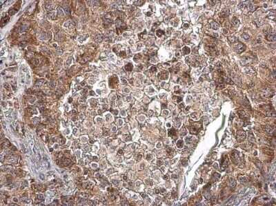 Immunohistochemistry-Paraffin: COX IV Isoform 2 Antibody [NBP3-13152] - COX IV Isoform 2 antibody detects COX IV Isoform 2 protein at mitochondria by immunohistochemical analysis. Sample: Paraffin-embedded human lung cancer. COX IV Isoform 2 stained by COX IV Isoform 2 antibody (NBP3-13152) diluted at 1:500. Antigen Retrieval: Tris-EDTA buffer, pH 9.0, 15 min