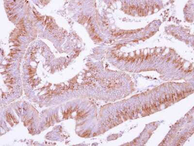 Immunohistochemistry-Paraffin: COX15 Antibody [NBP2-15976] - Immunohistochemical analysis of paraffin-embedded Colon ca, using antibody at 1:250 dilution.