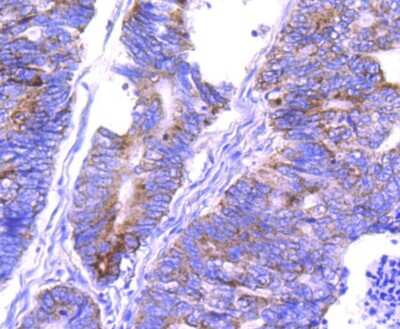 Immunohistochemistry-Paraffin: COX4 Antibody (JJ09-05) [NBP2-67889] - Analysis of paraffin-embedded human colon cancer tissue using anti-COX IV antibody. Counter stained with hematoxylin.
