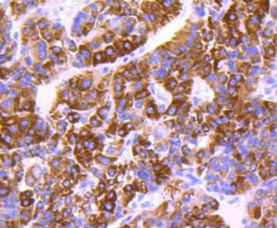 Immunohistochemistry-Paraffin: COX4 Antibody (JJ09-05) [NBP2-67889] - Analysis of paraffin-embedded human liver cancer tissue using anti-COX IV antibody. Counter stained with hematoxylin.