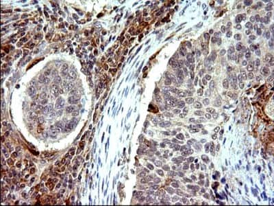 Immunohistochemistry: COX4NB Antibody (1D6) [NBP2-46343] - Analysis of Carcinoma of Human lung tissue.(Heat-induced epitope retrieval by 10mM citric buffer, pH6.0, 120C for 3min)