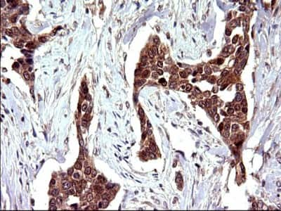 Immunohistochemistry: COX4NB Antibody (1D6) [NBP2-46343] - Analysis of Carcinoma of Human bladder tissue. (Heat-induced epitope retrieval by 10mM citric buffer, pH6.0, 120C for 3min)