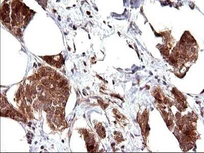 Immunohistochemistry: COX4NB Antibody (OTI1D6) - Azide and BSA Free [NBP2-71595] - Analysis of Adenocarcinoma of Human breast tissue . (Heat-induced epitope retrieval by 10mM citric buffer, pH6.0, 120C for 3min)