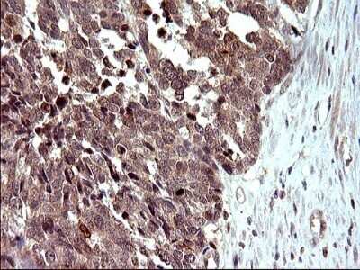 Immunohistochemistry: COX4NB Antibody (OTI1D6) - Azide and BSA Free [NBP2-71595] - Analysis of Adenocarcinoma of Human colon tissue. (Heat-induced epitope retrieval by 10mM citric buffer, pH6.0, 120C for 3min)
