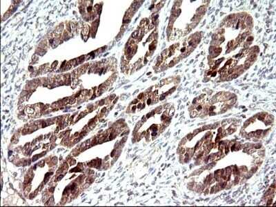 Immunohistochemistry: COX4NB Antibody (OTI1D6) - Azide and BSA Free [NBP2-71595] - Analysis of Adenocarcinoma of Human ovary tissue. (Heat-induced epitope retrieval by 10mM citric buffer, pH6.0, 120C for 3min)