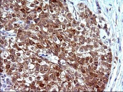 Immunohistochemistry: COX4NB Antibody (OTI1D6) - Azide and BSA Free [NBP2-71595] - Analysis of Carcinoma of Human liver tissue.(Heat-induced epitope retrieval by 10mM citric buffer, pH6.0, 120C for 3min)