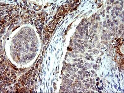Immunohistochemistry: COX4NB Antibody (OTI1D6) - Azide and BSA Free [NBP2-71595] - Analysis of Carcinoma of Human lung tissue.(Heat-induced epitope retrieval by 10mM citric buffer, pH6.0, 120C for 3min)