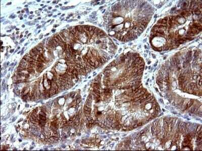 Immunohistochemistry: COX4NB Antibody (OTI1D6) - Azide and BSA Free [NBP2-71595] - Analysis of Carcinoma of Human pancreas tissue. (Heat-induced epitope retrieval by 10mM citric buffer, pH6.0, 120C for 3min)