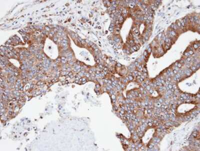 Immunohistochemistry-Paraffin: CPNE3 Antibody [NBP1-31453] - Human endo mitral ovarian cancer, using CPNE3 antibody at 1:100 dilution.Antigen Retrieval: Trilogy™ (EDTA based, pH 8.0) buffer, 15min.