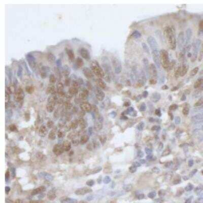 Immunohistochemistry-Paraffin: CPSF6 Antibody [NB100-61596] - FFPE section of human colon carcinoma. Antibody: Affinity purified rabbit anti-CPSF68 used at a dilution of 1:200 (1ug/ml). Detection: DAB