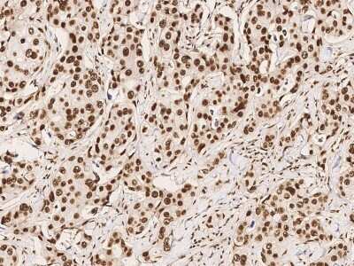 Immunohistochemistry-Paraffin: CPSF6 Antibody [NBP2-99189] - Immunochemical staining of human CPSF6 in human breast carcinoma with rabbit polyclonal antibody (1:1000, formalin-fixed paraffin embedded sections).