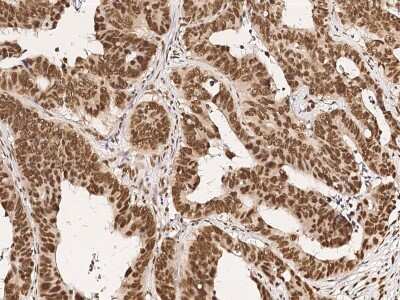 Immunohistochemistry-Paraffin: CPSF6 Antibody [NBP2-99189] - Immunochemical staining of human CPSF6 in human colon carcinoma with rabbit polyclonal antibody (1:1000, formalin-fixed paraffin embedded sections).