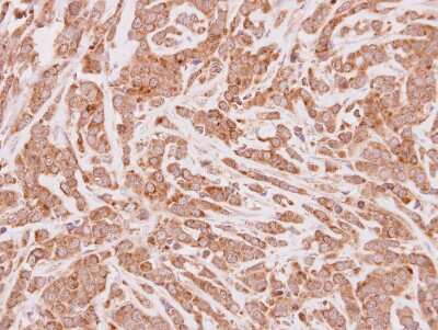 Immunohistochemistry-Paraffin: CPT1A Antibody [NBP2-15993] - MDA-MB157 xenograft, using CPT1A antibody at 1:250 dilution. Antigen Retrieval: Trilogy™ (EDTA based, pH 8.0) buffer, 15min.