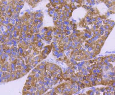 Immunohistochemistry-Paraffin: CPT2 Antibody (SN06-70) [NBP2-67699] - Analysis of paraffin-embedded human liver cancer tissue using anti-CPT2 antibody. Counter stained with hematoxylin.