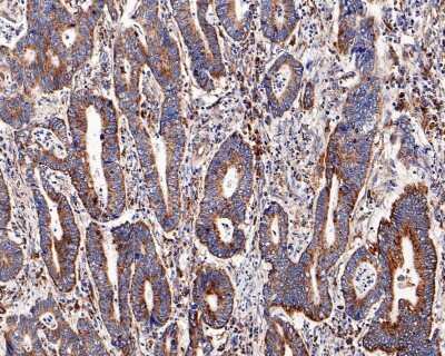 Immunohistochemistry-Paraffin: CPT2 Antibody (SN06-70) [NBP2-67699] - Analysis of paraffin-embedded human colon carcinoma tissue with Rabbit anti-CPT2 antibody. The section was pre-treated using heat mediated antigen retrieval with Tris-EDTA buffer (pH 9.0) for 20 minutes. The tissues were blocked in 1% BSA for 20 minutes at room temperature, washed with ddH2O and PBS, and then probed with the primary antibody for 1 hour at room temperature. The detection was performed using an HRP conjugated compact polymer system. DAB was used as the chromogen. Tissues were counterstained with hematoxylin and mounted with DPX.