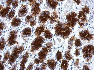 Immunohistochemistry-Paraffin: CPXCR1 Antibody [NBP2-15995] - Immunohistochemical analysis of paraffin-embedded Colon ca, using antibody at 1:500 dilution.