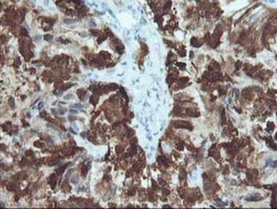 Immunohistochemistry: CRABP2 Antibody (OTI10D6) - Azide and BSA Free [NBP2-70448] - Staining of paraffin-embedded Adenocarcinoma of Human ovary tissue using anti-CRABP2 mouse monoclonal antibody.