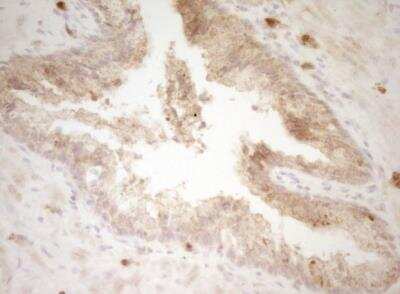 Immunohistochemistry-Paraffin: CRACC/SLAMF7 Antibody (OTI1F1) - Azide and BSA Free [NBP2-72107] - Staining of paraffin-embedded Adenocarcinoma of Human endometrium tissue using anti-SLAMF7 mouse monoclonal antibody. (Heat-induced epitope retrieval by 1 mM EDTA in 10mM Tris, pH8.5, 120 degrees C for 3min.