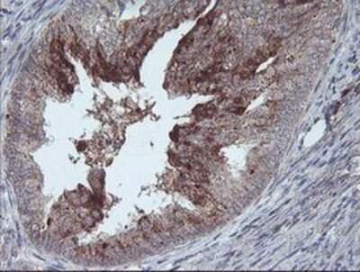 Immunohistochemistry: CRALBP Antibody (OTI1G6) - Azide and BSA Free [NBP2-71275] - Staining of paraffin-embedded Adenocarcinoma of Human endometrium tissue using anti-CRALBP mouse monoclonal antibody.