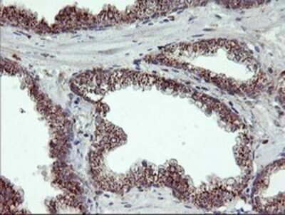 Immunohistochemistry: CRALBP Antibody (OTI1G6) - Azide and BSA Free [NBP2-71275] - Staining of paraffin-embedded Carcinoma of Human prostate tissue using anti-CRALBP mouse monoclonal antibody.