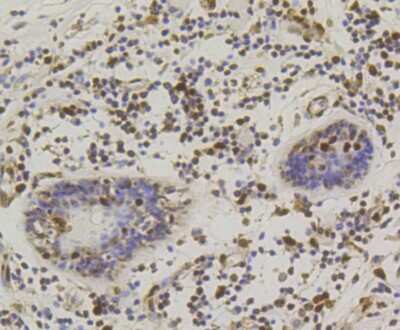 Immunohistochemistry-Paraffin: CREB Antibody (SA04-04) [NBP2-67274] - Analysis of paraffin-embedded human breast carcinoma tissue using anti-CREB antibody. Counter stained with hematoxylin.