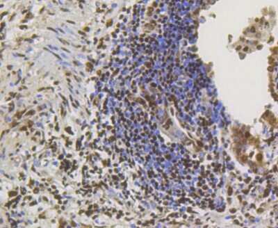 Immunohistochemistry-Paraffin: CREB Antibody (SA04-04) [NBP2-67274] - Analysis of paraffin-embedded human lung cancer tissue using anti-CREB antibody. Counter stained with hematoxylin.