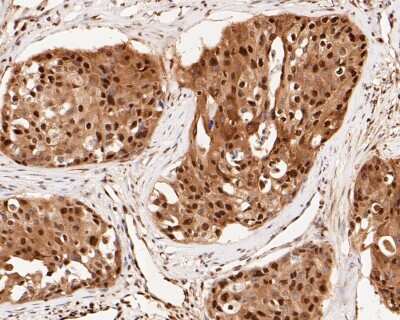 Immunohistochemistry-Paraffin: CREB Antibody (SA04-04) [NBP2-67274] - Immunohistochemical analysis of paraffin-embedded human breast carcinoma tissue using anti-CREB antibody. The section was pre-treated using heat mediated antigen retrieval with sodium citrate buffer (pH 6.0) for 20 minutes. The tissues were blocked in 5%